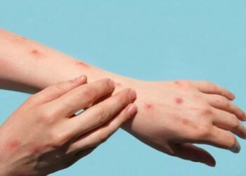 विश्वमा मंकीपक्सका संक्रमितको संख्या ७० हजार