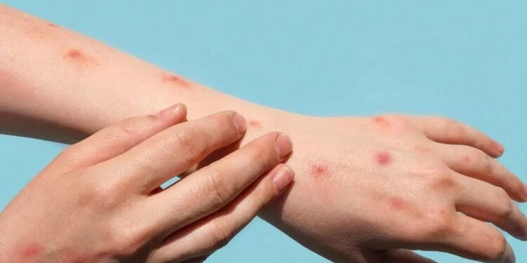 विश्वमा मंकीपक्सका संक्रमितको संख्या ७० हजार