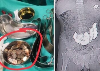 निरन्तर पेट दुखेपछि अपरेशन गरेर हेर्दा १८७ वटा सिक्का फेला