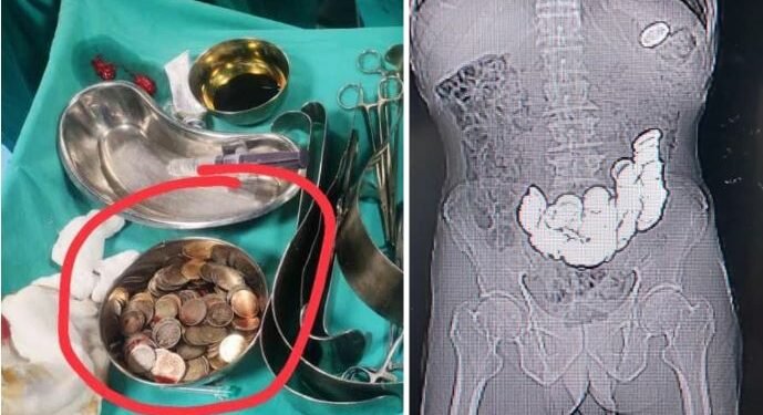 निरन्तर पेट दुखेपछि अपरेशन गरेर हेर्दा १८७ वटा सिक्का फेला