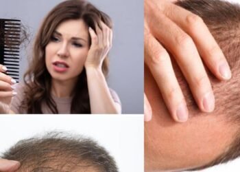 कपाल झर्ने समस्या छ ? यसरी गर्नुस् रोकथाम