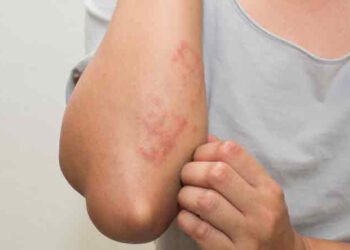 विचार पु-याउनुहोस्, ग्यास चुल्होबाट पनि एलर्जी हुनसक्छ