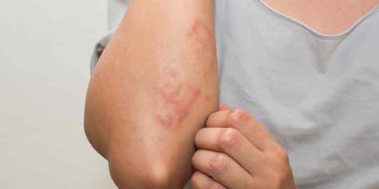 विचार पु-याउनुहोस्, ग्यास चुल्होबाट पनि एलर्जी हुनसक्छ