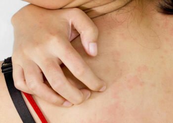 एलर्जी रोगमा खानपानको महत्व