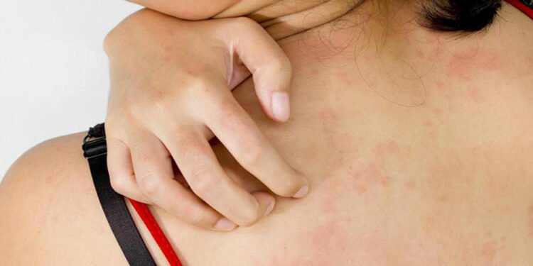 एलर्जी रोगमा खानपानको महत्व