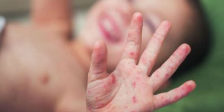 नेपालगञ्जमा समुदाय स्तरमै फैलियो दादुरा महामारी