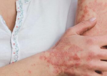 यस्तो छ सोराइसिस रोगको घरेलु उपचार