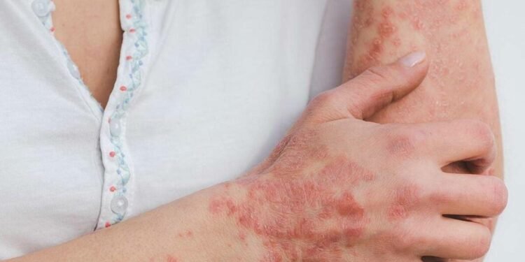 यस्तो छ सोराइसिस रोगको घरेलु उपचार