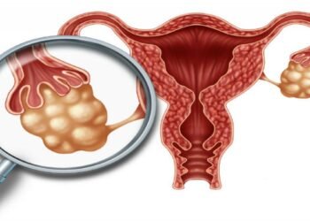 ओभेरियन सिस्ट रोग र यसबाट बच्ने उपाय