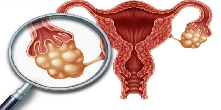 ओभेरियन सिस्ट रोग र यसबाट बच्ने उपाय