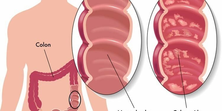 यस्तो छ कोलाइटिस रोगको घरेलु उपचार