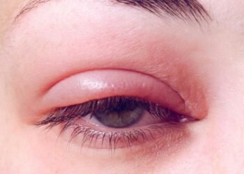हेल्थ टिप्सः आनो आउँदाको घरेलु उपचार