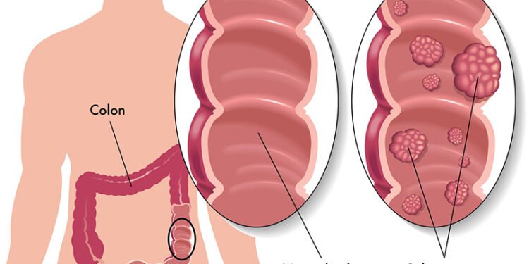 हेल्थ टिप्सः आन्द्रामा घाउ भए के खाने ?