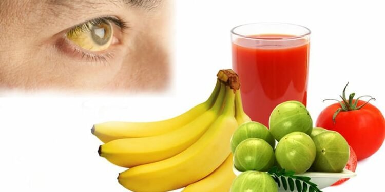 हेल्थ टिप्सः कमलपित्त रोगको घरेलु उपचार विधि