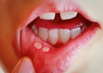 मुखमा खटिरा आँउदा उपनाउनुस् यी घरेलु उपाए