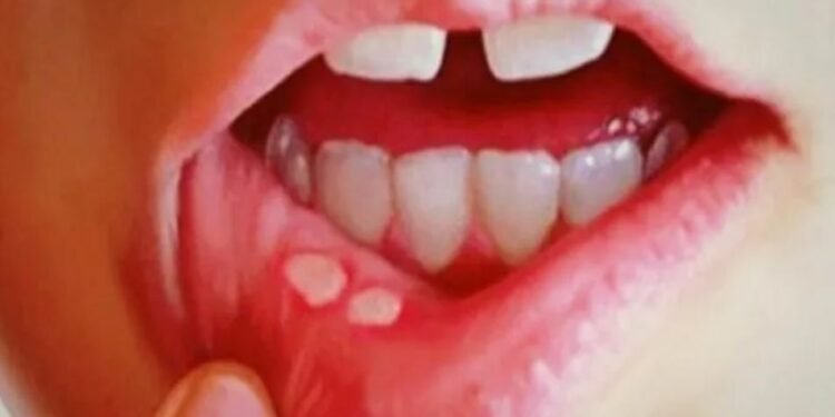 मुखमा खटिरा आँउदा उपनाउनुस् यी घरेलु उपाए