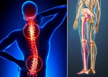 हेल्थ टिप्स्ः साइटिका रोग र यसको घरेलु उपचार