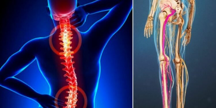 हेल्थ टिप्स्ः साइटिका रोग र यसको घरेलु उपचार