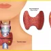 थाइराइड के हो, कस्ता हुन्छन् लक्षण ?