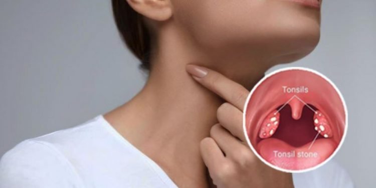 हेल्थ टिप्सः टन्सिल छिट्टै निको पार्ने घरायसी उपचार