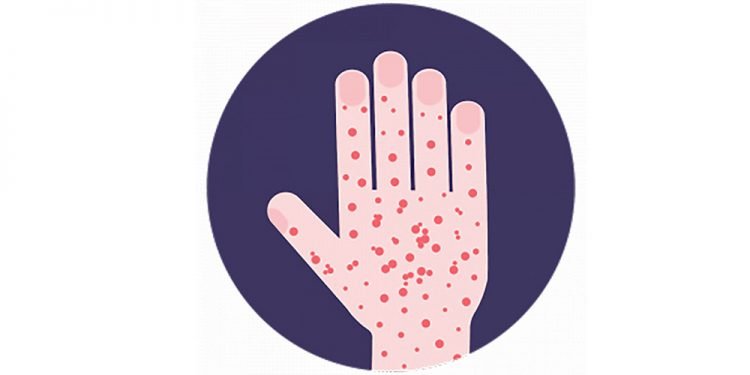 १६ जिल्लाका एक हजार तीन जना दादुराबाट संक्रमित