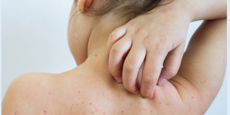 दादुराबाट बच्न के गर्ने ? यस्ता छन् उपाय