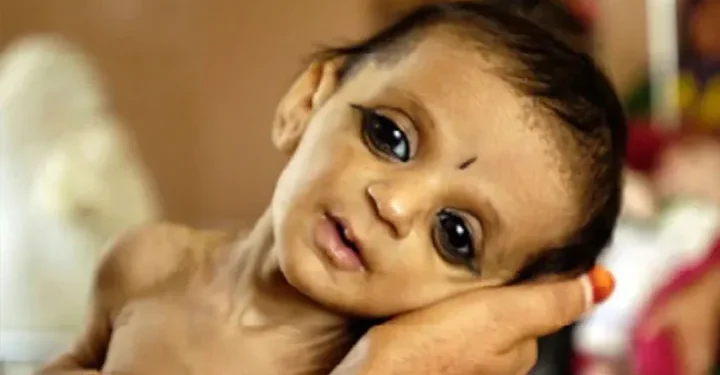 बालबालिकामा कुपोषणको समस्या हट्दै