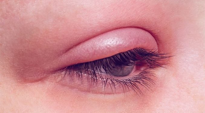 आँखा पाक्ने रोगबाट बच्न सरसफाइ र सामाजिक दूरी कायम गर्न सुझाव