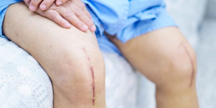 ३२ जना घुँडाको बिरामीको निःशुल्क प्रत्यारोपण