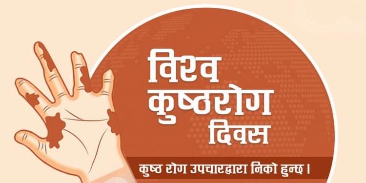आज ७१औँ विश्व कुष्ठरोग दिवसः मधेस प्रदेशमा अधिक कुष्ठरोगी