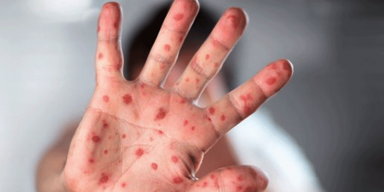 नाइजेरियामा दादुराका कारण १९ बालबालिकाको मृत्यु