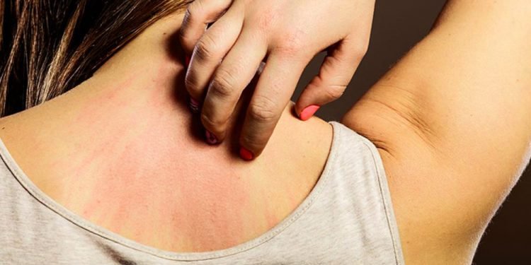 एलर्जी रोगमा खानपानको महत्व