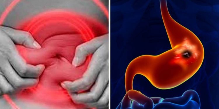 पेप्टिक अल्सर र यसबाट बच्ने घरेलु उपाय