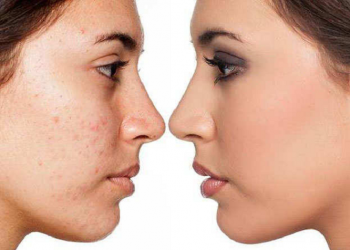 सोराइसिस रोगको घरेलु उपचार