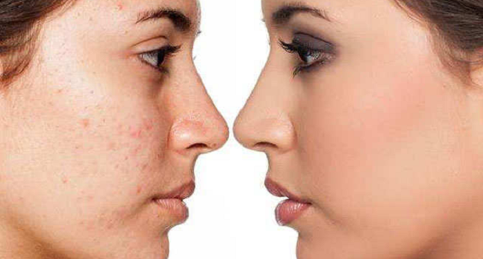 सोराइसिस रोगको घरेलु उपचार