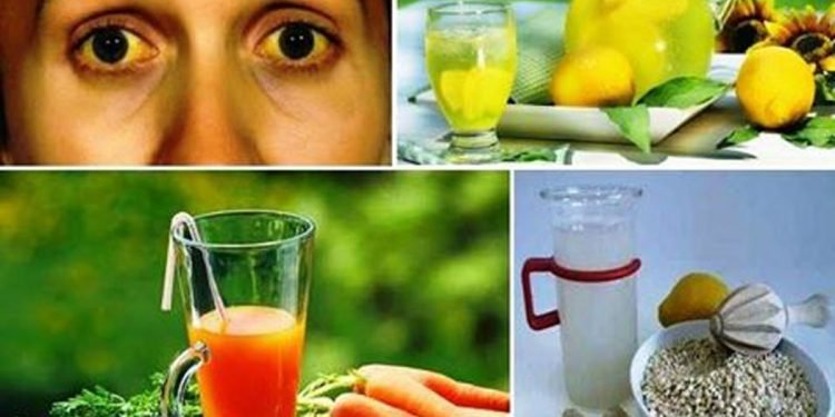 कमलपित्त रोगको घरेलु उपचार विधि