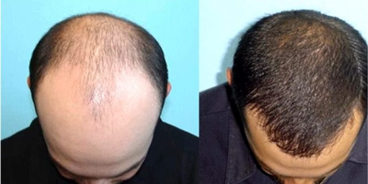 कपाल झर्ने समस्याको अचुक घरेलु समाधान