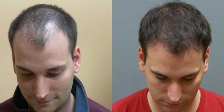 खोइरो रोगको घरेलु समाधान