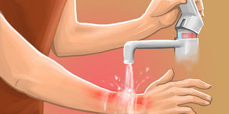 आगो वा तातो वस्तुले पोलेमा घरैमा गर्न सकिने प्राथमिक उपचार