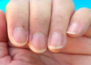 औंलाहरूको छाला किन निस्कन्छ ?