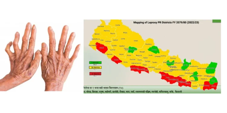नेपालमा सबैभन्दा बढी नयाँ कुष्ठरोगका बिरामीहरु मधेस प्रदेशमा