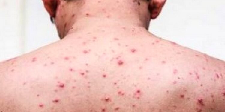 सुर्नयामा ठेउला सङ्क्रमणबाट बालबालिका प्रभावित