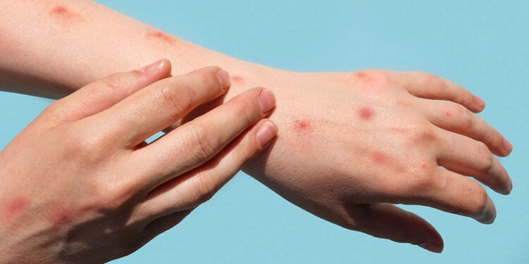 बाँकेमा छाला रोगका बिरामी बढ्दै