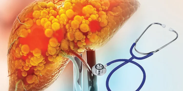 फ्याटी लिभर रोग: लक्षण, कारण, निदान र उपचार