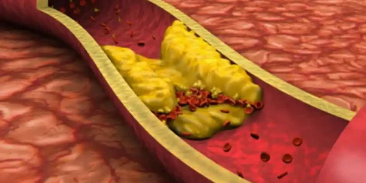 शरीरमा यी संकेतहरू देखिन थाले तुरुन्तै परीक्षण गर्नुस्, कोलेस्ट्रोल बढेको हुनसक्छ