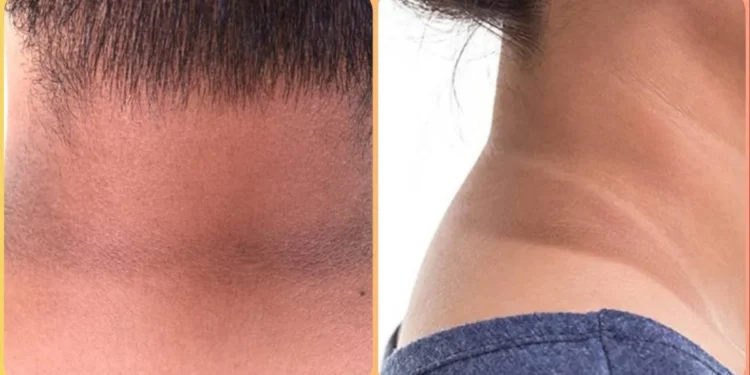 घाँटी वरिपरि कालो घेरा देखिन थालेको छ ?