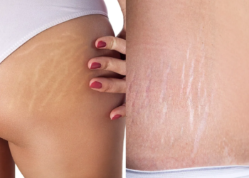 शरीरमा सेतो धर्सा आउने कारण र हटाउने उपाय