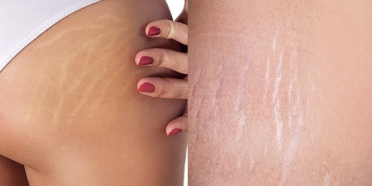 शरीरमा सेतो धर्सा आउने कारण र हटाउने उपाय