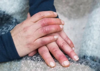 जाडोमा औंलाहरू सुन्निन्छ ? यस्ता छन्, घरेलु उपायहरू