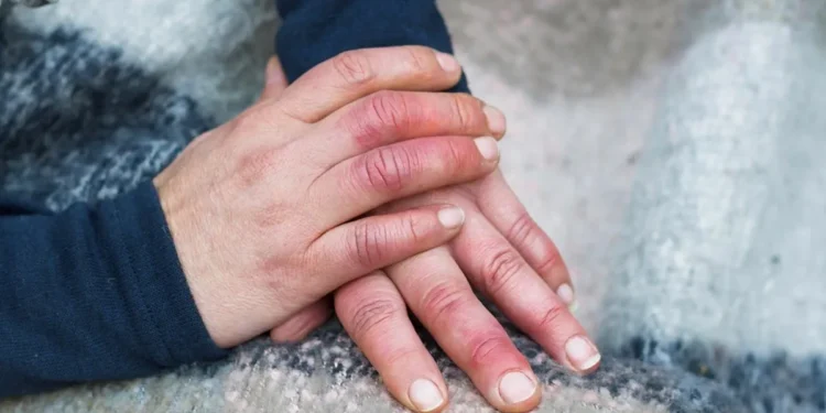 जाडोमा औंलाहरू सुन्निन्छ ? यस्ता छन्, घरेलु उपायहरू